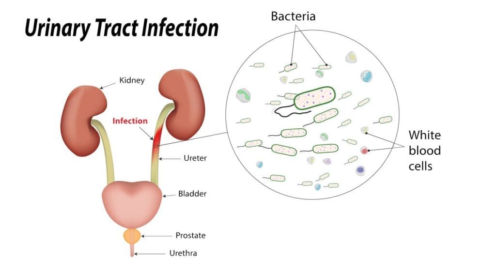 Urinary Tract Infection