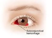 Eye Hemorrhage