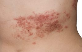 What are Shingles and how can they be prevented?