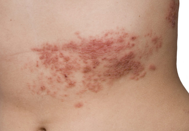 What are Shingles and how can they be prevented?